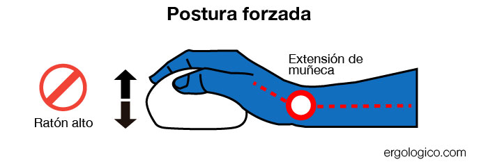 Campaña de prevención del Sindrome de Tunel Carpiano